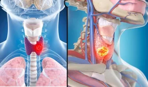 inside image of throat: गले का कैंसर : बचाव