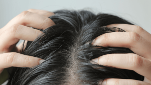 सिर में खुजली / Itching scalp