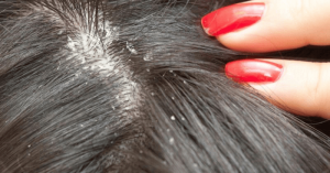 सिर में खुजली / Itching scalp