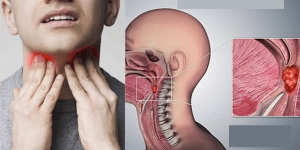 गले के कैंसर के लक्षण/Symptoms of Throat Cancer
