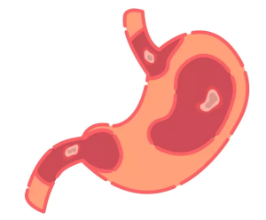खाली पेट और अल्सर/empty stomach and ulcers