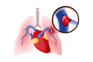 पल्मोनरी एम्बोलिज्म/Pulmonary Embolism