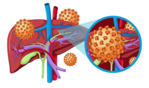 हेपेटाइटिस को समझना/Understanding Hepatitis