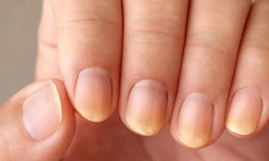 नाखूनों का स्वास्थ्य/Nail health